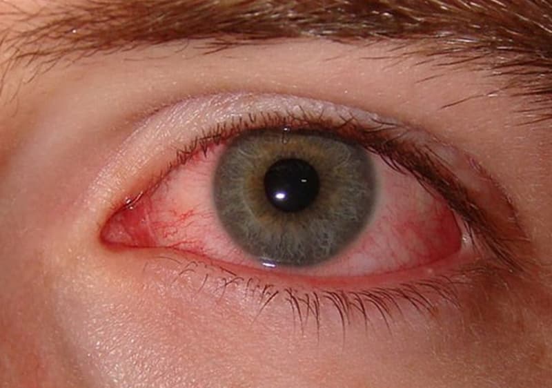 Ojo seco