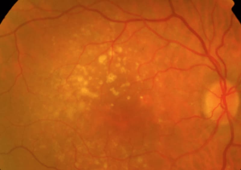 Degeneración Macular