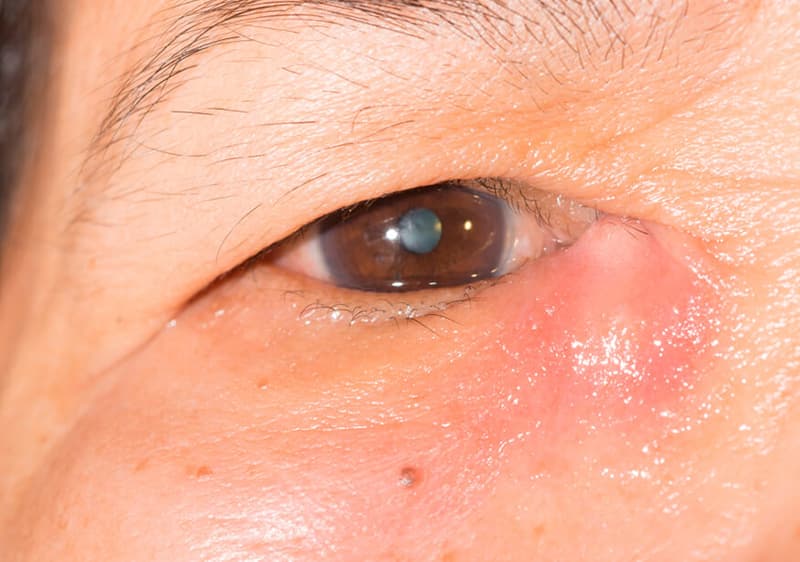 Enfermedades de vía lagrimal