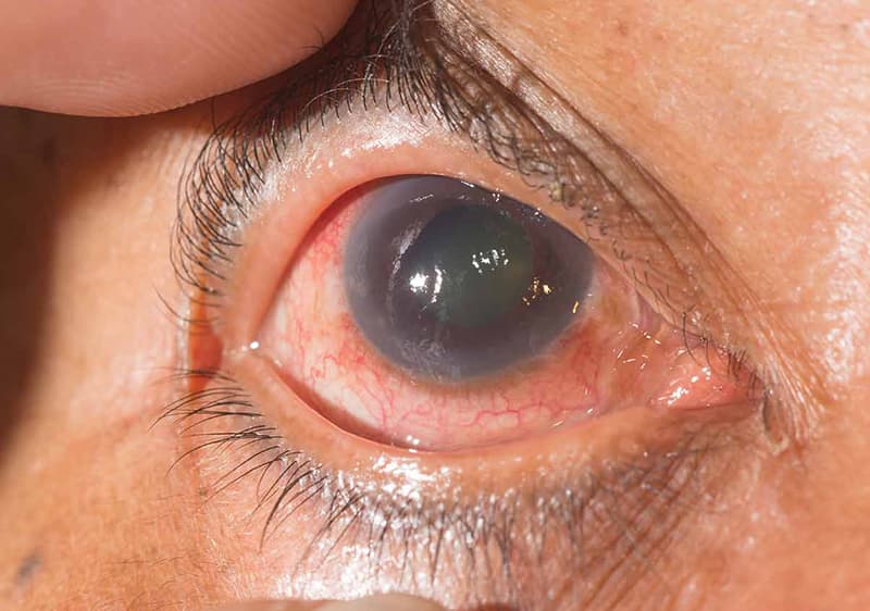 Glaucoma y Glaucoma Neovascular