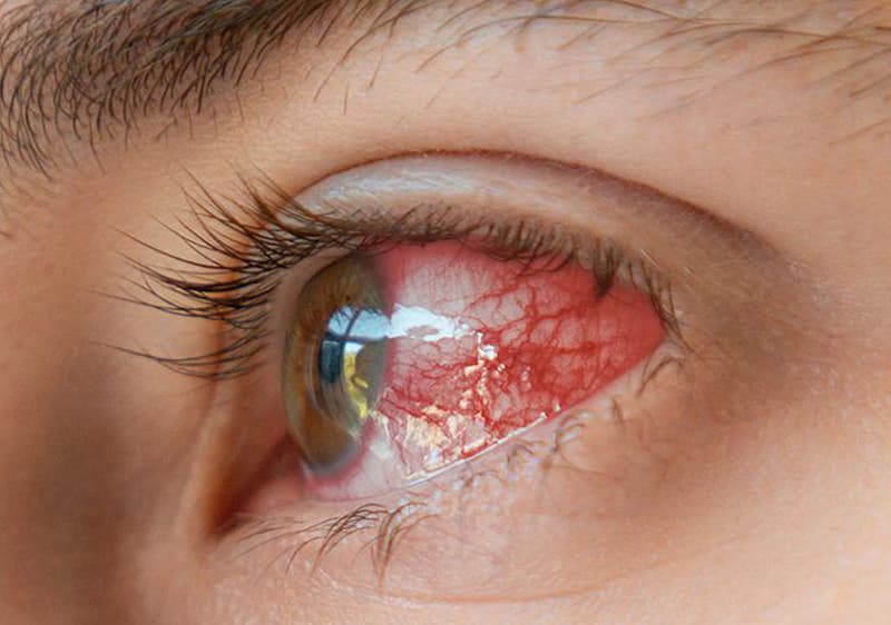 Infecciones oculares