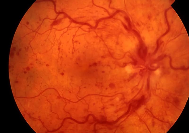 Oclusiones Vasculares de la Retina