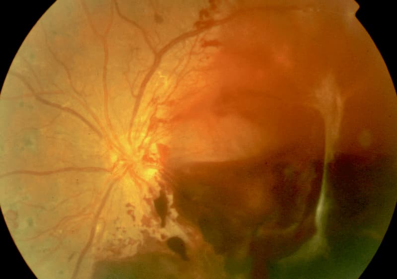 Retinopatía Diabética