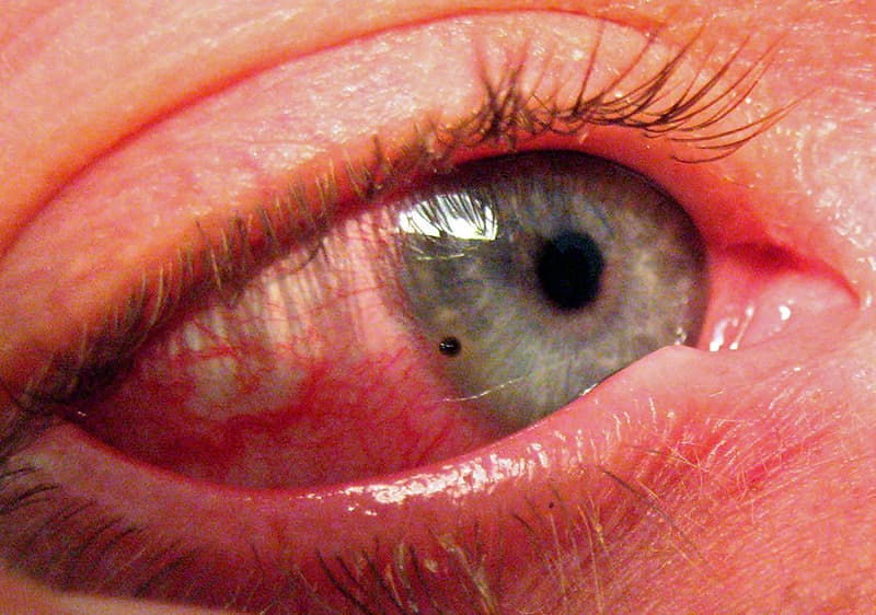 Trauma ocular abierto y cerrado