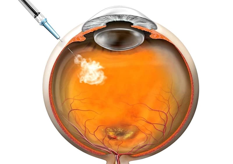 Aplicación de Antiangiogénico