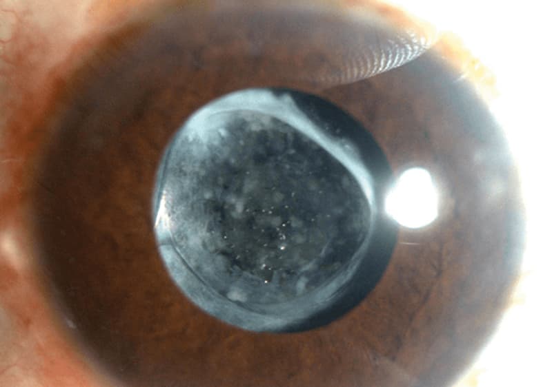 Capsulotomías con Láser YAG