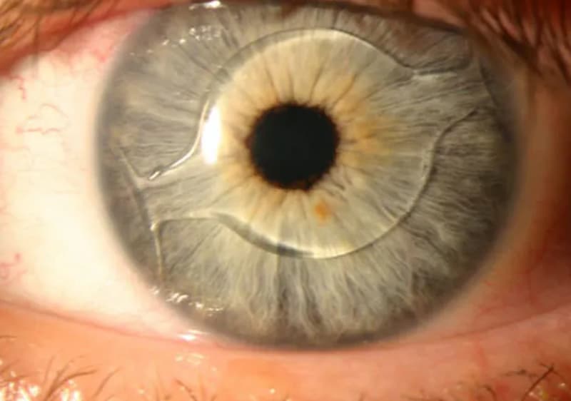 Cirugía de catarata con implante ocular