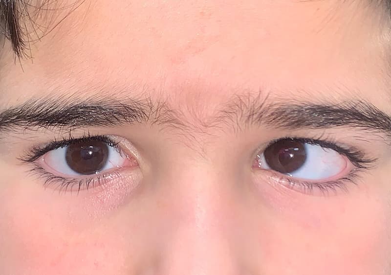 Cirugía de Estrabismo