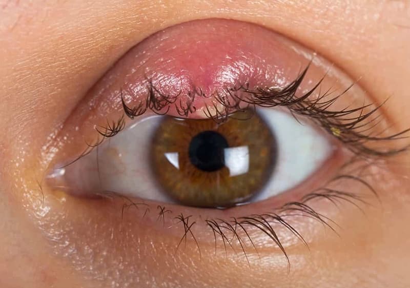 Excisión de Chalazión