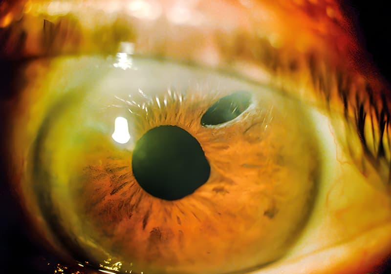 Iridotomía con Láser YAG