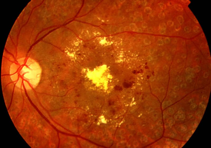 Tratamiento Láser para Retinopatía Diabética